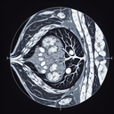 МРТ мамографія молочних залоз грудей